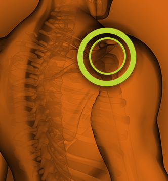 Fibromyalgia pain points.